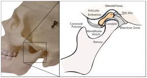 TMJ Disorder - TMD