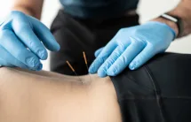 Dry Needling IMS at Acceleration Physiotherapy Sherwood Park